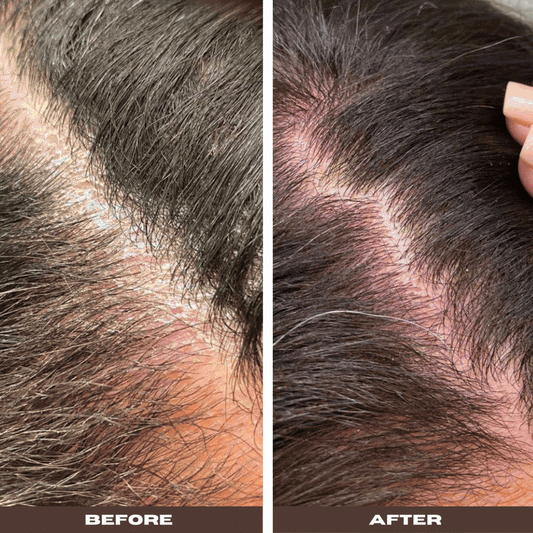YeastDefense®️ Seborrheic Scalp Solution | Herbal Leave-in